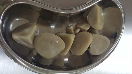 Bladder Stones
