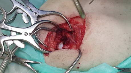 Removing the ball of a joint socket