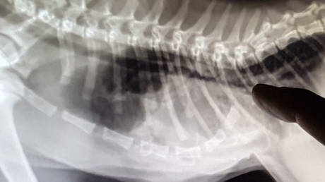 An unusual chest deformity