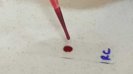 Cross-Matching Blood
