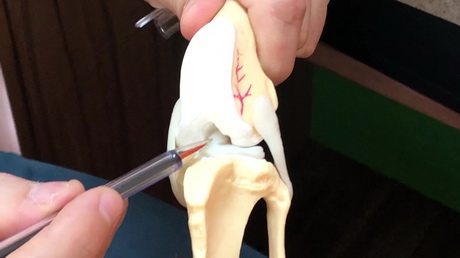 The TTA technique to repair those <br> tricky knees and ligaments