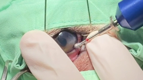 Corneal ulcer treatment with a diamond burr